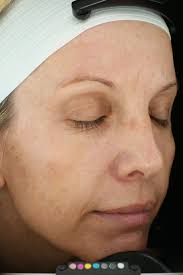 R2 Technologies Disrupts the Aesthetics Industry with Its Groundbreaking  Glacial Rx™ Treatment