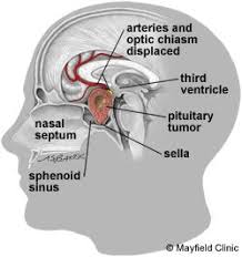 Endoscopic Transsphenoidal Surgery