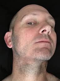 Is hair loss around radiation treatment normal?