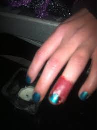During application of acrylic nails, the entire nail towards lower cuticle is covered and sealed with acrylic. Lifting On Acrylic Nails New Expression Nails