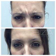 Luego que pasó ese tiempo pueden aplicarte una nueva dosis, pero debes tener en cuenta que solo te la pueden colocar una vez en la misma ocasión, no permitas que te coloquen dos inyecciones en una misma sesión. Precio De Botox Cual Es El Precio 130 Zona Facial