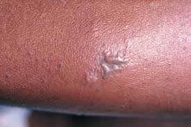 At the same time, it is better to check and treat between partners together to avoid cross infection and aggravation. Gonorrhea Wikipedia