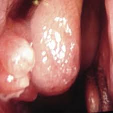 The mucosa is a very wet layer that helps protect the inside of your nose and sinuses and humidifies the air you breathe. Intraoperative Endoscopic View Demonstrating Polyps In Middle Nasal Download Scientific Diagram