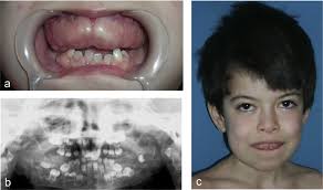 Familial cherubism: the experience of the Moscow Central Institute for  Stomatology and Maxillo-Facial Surgery