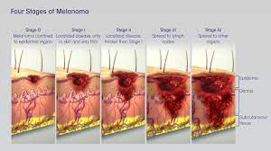 The marks on skin has sudden color change, itch, and irritation: Melanoma Skin Cancer Depicted Explained Using 3d Medical Animation