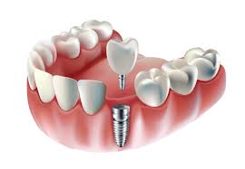 Tooth Implant Process: What to Expect