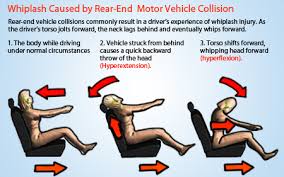 Getting the best legal support for average settlement for car accident causing a whiplash. Whiplash Guide For Patients Causes And Treatment