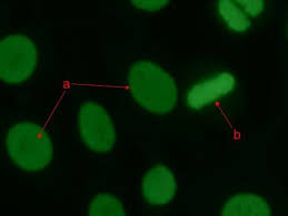 Image result for ANA Staining Pattern