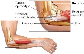 It is most commonly known as golfers elbow or technically speaking medial epicondylitis (me). Lateral Medial Epicondylitis