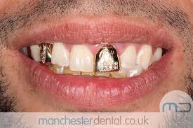 Check spelling or type a new query. Gold Teeth Manchester Manchester Dental