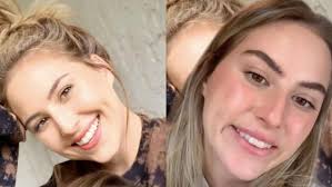 La toxina botulínica que se inyecta garantiza un resultado realmente natural. Una Mujer Se Hace Viral Al Mostrar Como El Botox Arruino Su Sonrisa Y Advierte De Los Peligros De La Toxina