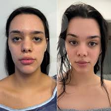 A lot of you ask us the following question: ✨How do I know if I'm good  candidate for the Renate lift ? ➡️ Droopy eyebrows. ➡️Saggy, droopy upper  and lower eyelids. ➡️Saggy