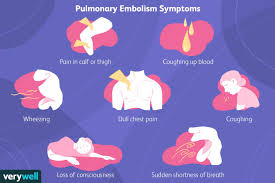 We did not find results for: Symptoms Of Pulmonary Embolism
