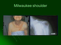 Milwaukee shoulder syndrome is a severe destructive arthritis of the glenohumeral joint with loss of the rotator cuff associated with the presence of bcp crystals. Calcium Containing Crystals Major Manifestations Major Manifestations Acute Periarthritis Acute Periarthritis Destructive Arthropathy Destructive Arthropathy Ppt Download