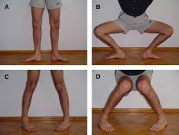 Image result for McMurray Test