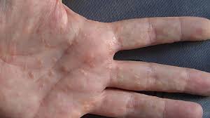 The rash on your palms and feet could be an infection by fungus or scabies or an allergic reaction. Dyshidrotic Eczema Overview Causes Diagnosis And Pictures