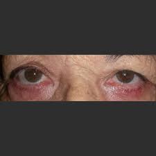 Image result for Entropion