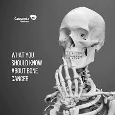 Bone cancer can begin in any bone in the body, but it most commonly affects the pelvis or the long bones in the arms and legs. Aching Bones Ask Your Doctor Of The Possibility Of Bone Cancer