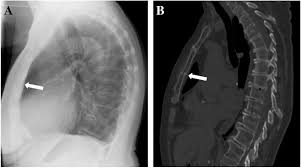 Image result for Sternal Fracture