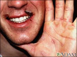 Image result for Erythema Multiforme Causes