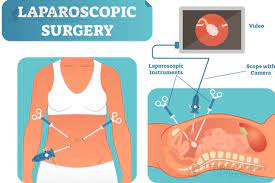 Smokers will have to stop smoking 12 weeks before surgery. Sleeve Surgery Scars Scaring After Gastric Sleeve Surgery