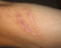 In rat studies, aloe vera topical. Scar Wikipedia