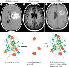 Cancer Stem Cells Cause Tumour Regrowth After Apparently Successful Download Scientific Diagram