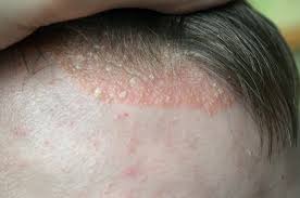 E enquanto alguns remendos da psoríase podem ser fáceis de esconder com o cabelo, outros podem ser grandes o suficiente para serem perceptíveis. Psoriase No Couro Cabeludo Pode Ser Confundida Com Caspa Blog Bem Estar