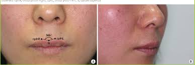 Pdf A New Method For Creating A Definite Philtrum By The Flipping Of An Orbicularis Oris Muscle Flap In A Patient With An Indistinct Philtrum Semantic Scholar It's called the philtrum and this is why it exists. creating a definite philtrum