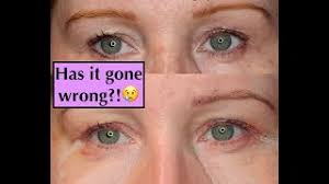 Hooded eyes are very common and many people and celebrities have hooded eyelids. Blepharoplasty Experience Uk Eyelid Surgery Hooded Eyes 1 Wk Stitches Removed Youtube