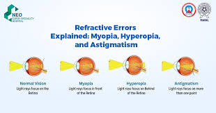 Image result for Refractive Error