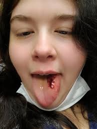 Pregnancy and epilepsy can be challenging