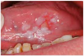 Onset is often over months. Current Aspects On Oral Squamous Cell Carcinoma