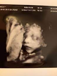 Baby S Head Measuring Small Positive Stories September 2020 Babies Forums What To Expect