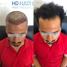 3000 Greft Ekimi Ile Max Sayi Natural On Cizgi Ve Profesyonel Ekibin Ellerinde Bizimle Guvendesiniz الان في مركز اسطنبول لزراعة الشعر وبخبرة الكادر الطبي نقوم