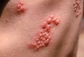 Image result for Varicella zoster on human skin