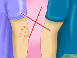 La sarna humana o escabiosis es infección cutánea altamente contagiosa. Como Evitar Contagiarse De Sarna 9 Pasos Con Imagenes