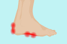 Foot pain may be in the arch of the foot, along the outer side of the foot, on the sole or in the ball of your foot, or in the toes, heels or ankles. What Is Enthesitis Causes Symptoms Treatments