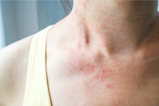Ngứa da cổ: Nguyên nhân và cách khắc phục • Hello Bacsi