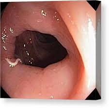 Image result for Pinworm Test