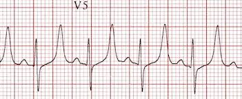 Image result for Hyperkalemia Management
