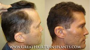 Hair Treatment Cost For Men And Women in Florida Hillsborough Godins Golden  Acres