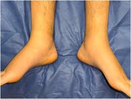 Image result for Yellow nail syndrome feet