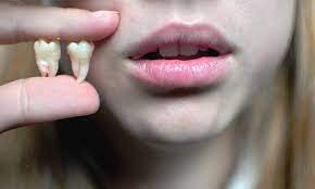 Sonhar Com Dente Arrancado Simbolismo E Significado Segredos Do Sonho Uma pessoa nova ou mesmo um bebê trará novidades e alegrias a você e a no geral, sonhar com arrancando o dente significa que você passará por uma fase de prejuízos financeiros. sonhar com dente arrancado simbolismo