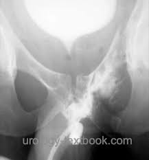 Image result for Retrograde Urethrogram