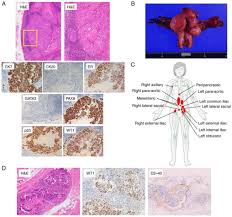 Image result for Primary Tumor Localization