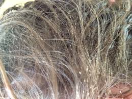 Pin On How To Remove Head Lice Naturally