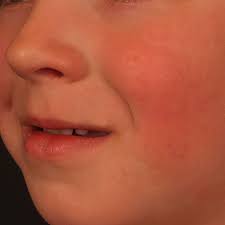 Im sommer erscheinen die herde im vergleich zur umgebenden gebräunten haut heller ( pityriasis versicolor alba), im winter dunkler. Erythem Altmeyers Enzyklopadie Fachbereich Dermatologie