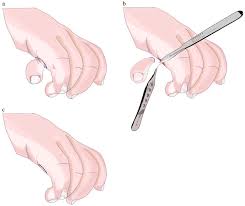 Image result for Supernumerary Digit