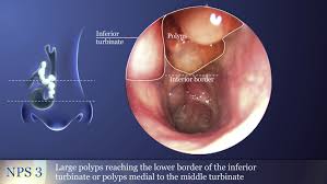 Nasal polyps grow in inflamed tissue of the nasal mucosa. Efficacy And Safety Of Omalizumab In Nasal Polyposis 2 Randomized Phase 3 Trials Sciencedirect